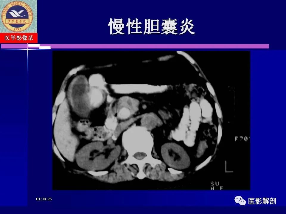 影像PPT - 【PPT】胆道系统病变的CT诊断-19