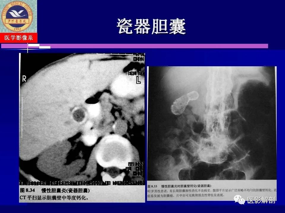 影像PPT - 【PPT】胆道系统病变的CT诊断-20