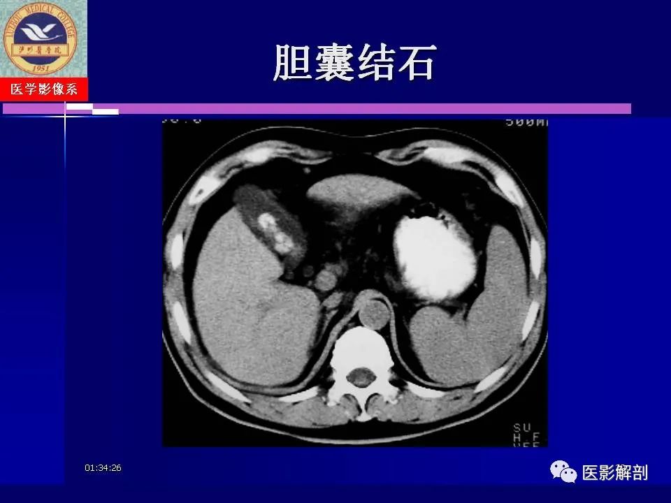 影像PPT - 【PPT】胆道系统病变的CT诊断-29