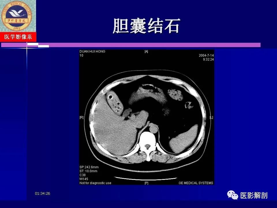 影像PPT - 【PPT】胆道系统病变的CT诊断-30