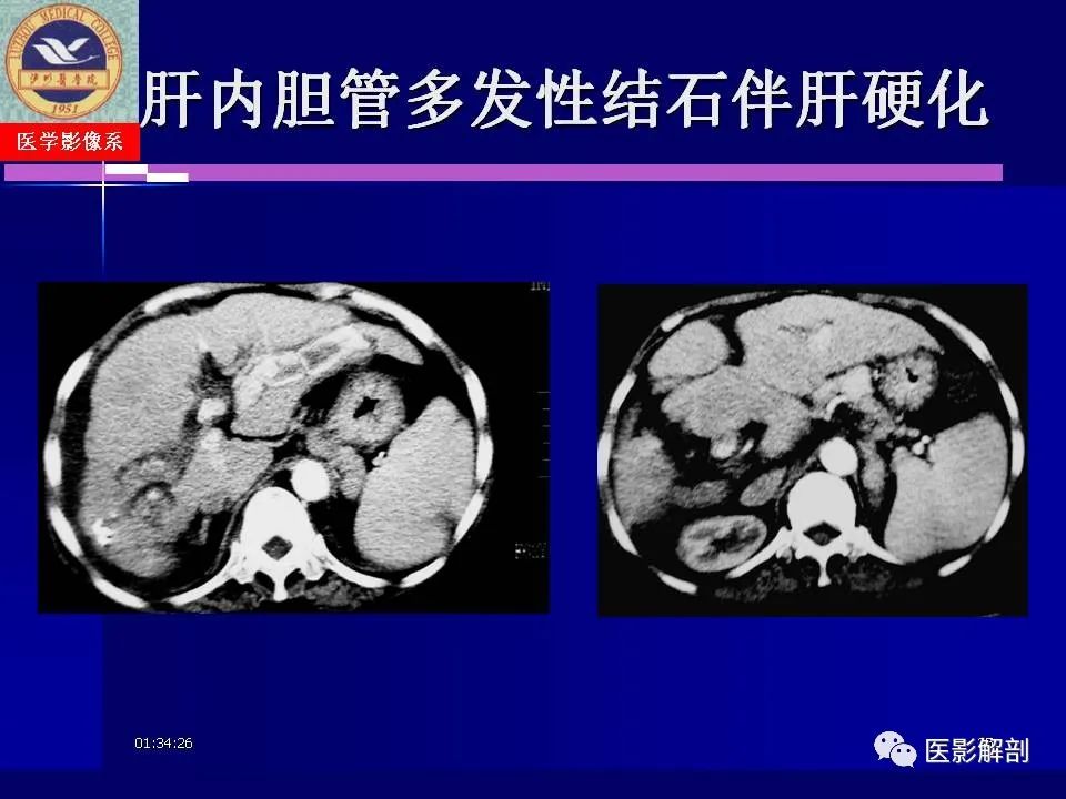 影像PPT - 【PPT】胆道系统病变的CT诊断-35