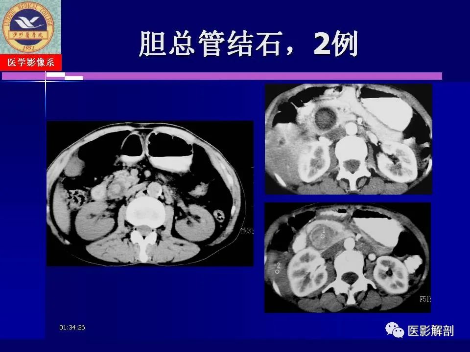 影像PPT - 【PPT】胆道系统病变的CT诊断-36