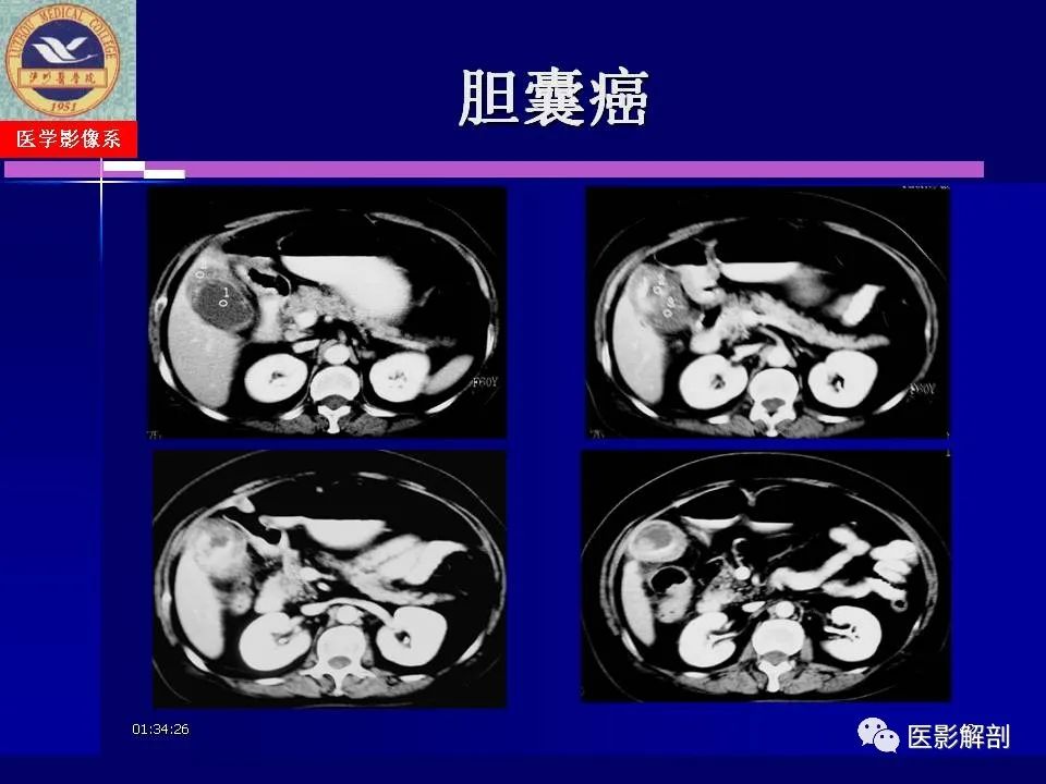 影像PPT - 【PPT】胆道系统病变的CT诊断-42