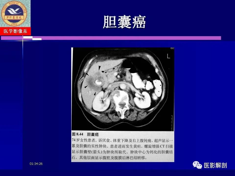 影像PPT - 【PPT】胆道系统病变的CT诊断-43