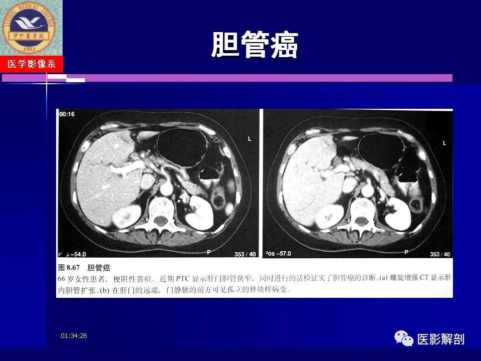 影像PPT - 【PPT】胆道系统病变的CT诊断-52