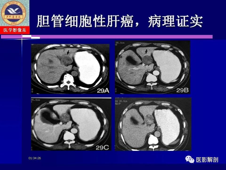 影像PPT - 【PPT】胆道系统病变的CT诊断-53