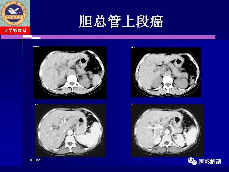 影像PPT - 【PPT】胆道系统病变的CT诊断-55