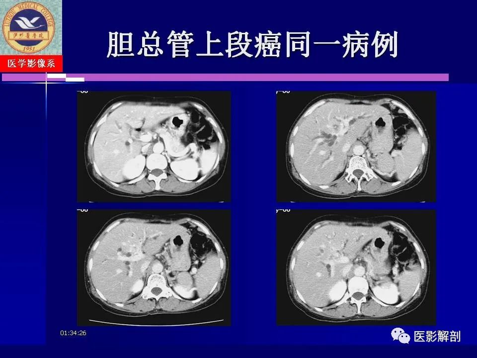 影像PPT - 【PPT】胆道系统病变的CT诊断-56