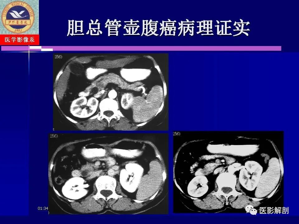影像PPT - 【PPT】胆道系统病变的CT诊断-57