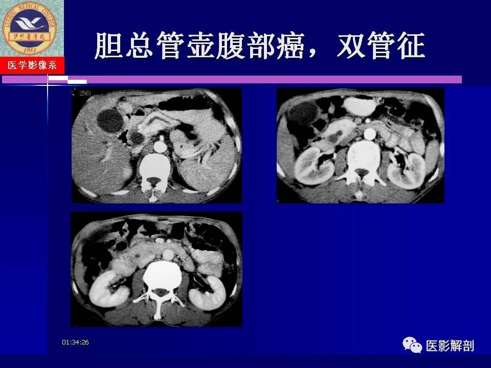 影像PPT - 【PPT】胆道系统病变的CT诊断-58