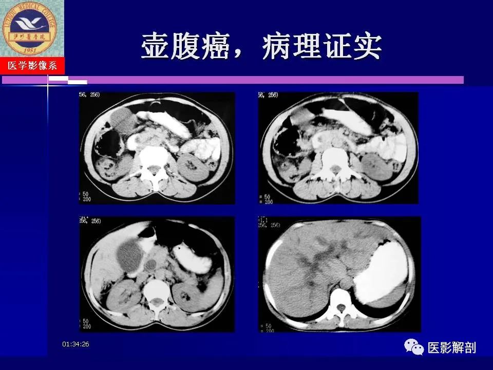 影像PPT - 【PPT】胆道系统病变的CT诊断-59