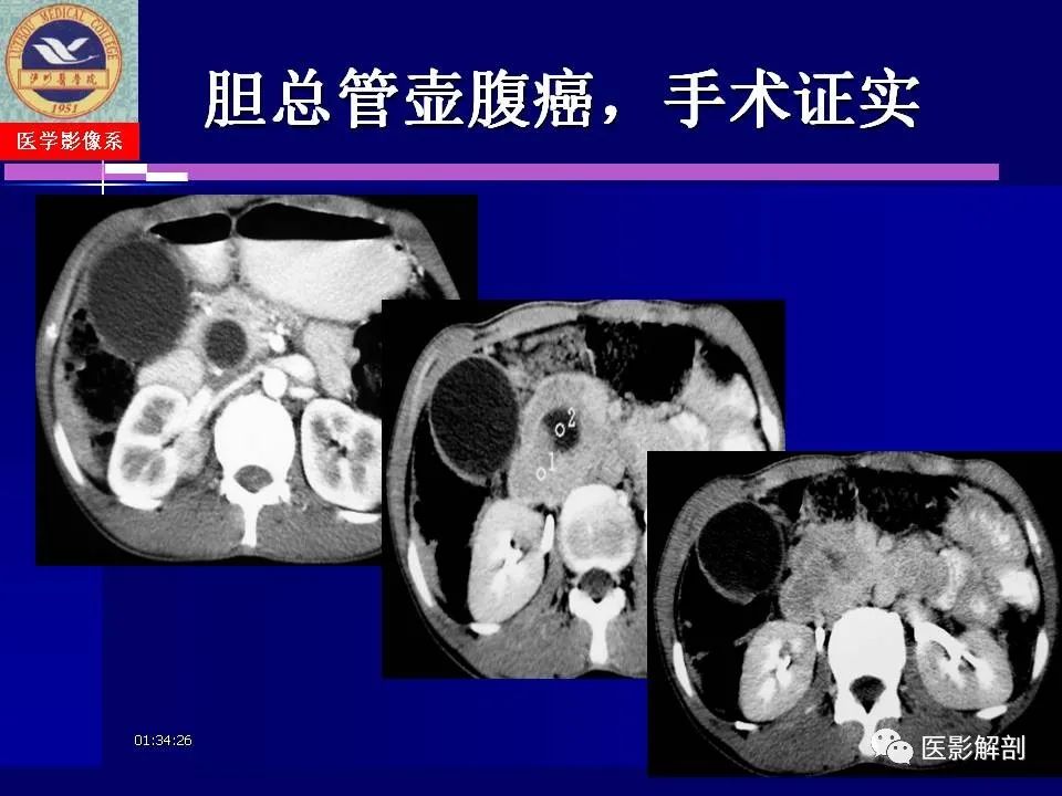 影像PPT - 【PPT】胆道系统病变的CT诊断-60