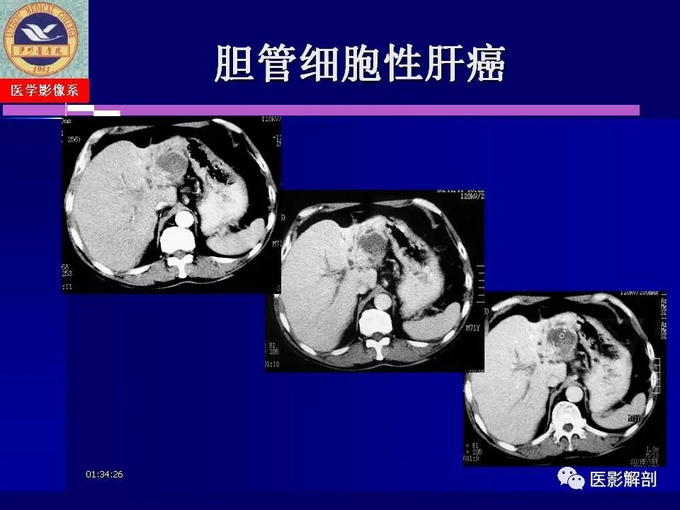 影像PPT - 【PPT】胆道系统病变的CT诊断-61