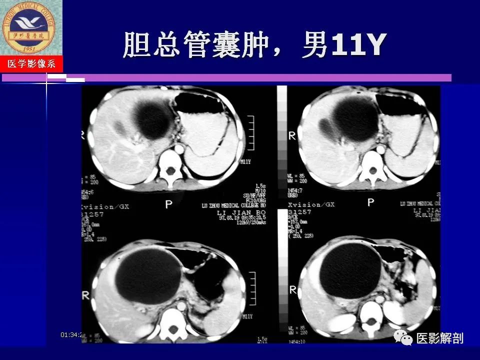 影像PPT - 【PPT】胆道系统病变的CT诊断-64