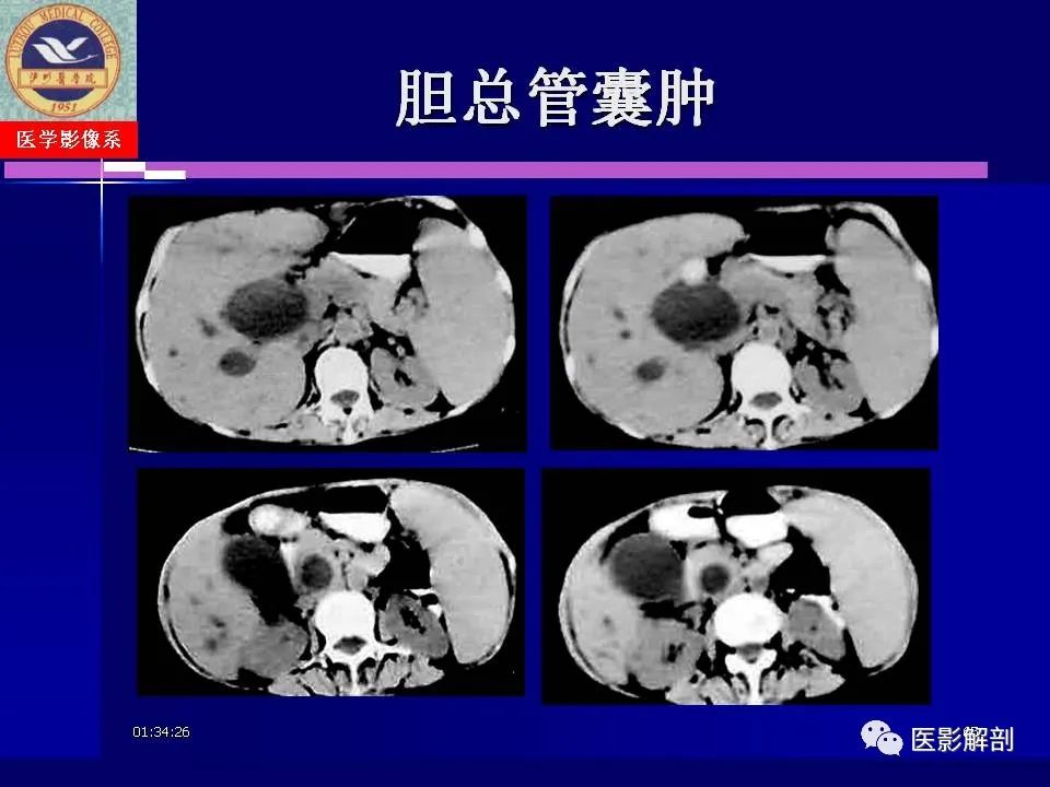 影像PPT - 【PPT】胆道系统病变的CT诊断-65