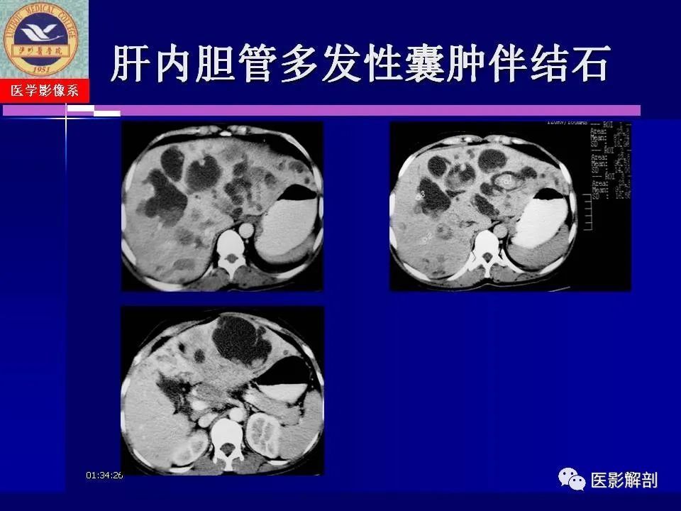 影像PPT - 【PPT】胆道系统病变的CT诊断-67