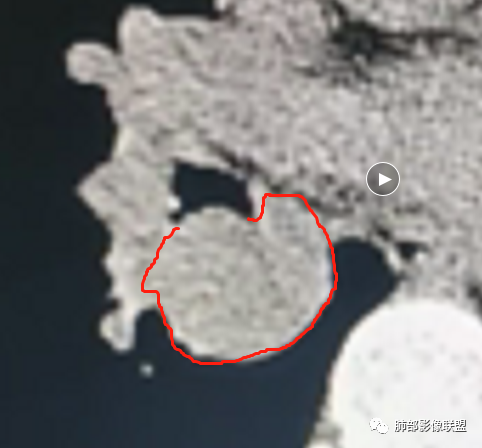 影像PPT - 【病例】右肺门区高强化肿块—类癌1例CT影像-87 影像PPT - 【病例】右肺门区高强化肿块—类癌1例CT影像-87