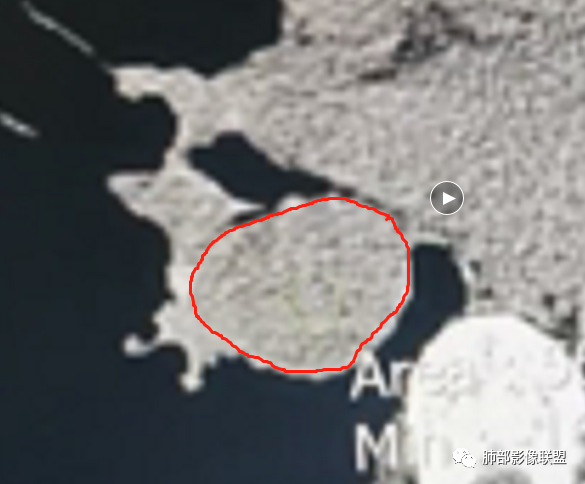 影像PPT - 【病例】右肺门区高强化肿块—类癌1例CT影像-88 影像PPT - 【病例】右肺门区高强化肿块—类癌1例CT影像-88