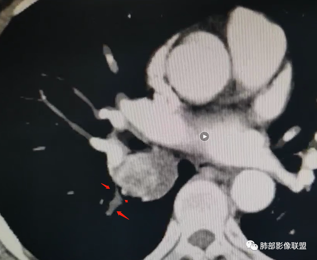 影像PPT - 【病例】右肺门区高强化肿块—类癌1例CT影像-95 影像PPT - 【病例】右肺门区高强化肿块—类癌1例CT影像-95
