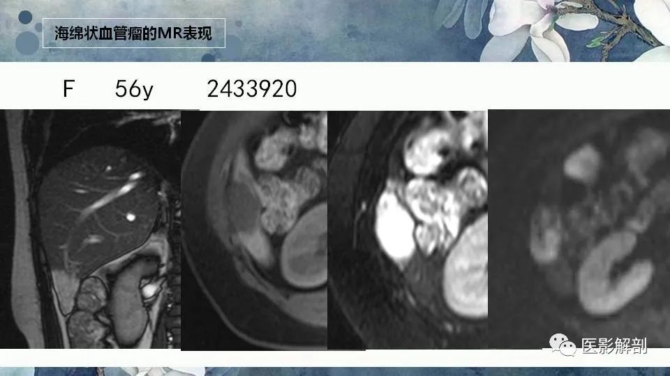 影像PPT - 【PPT】肝血管瘤的分型与影像学诊断-11
