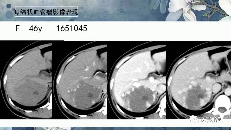 影像PPT - 【PPT】肝血管瘤的分型与影像学诊断-10