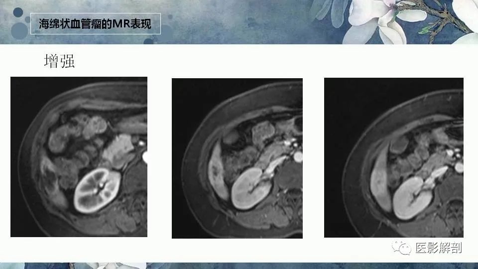 影像PPT - 【PPT】肝血管瘤的分型与影像学诊断-12