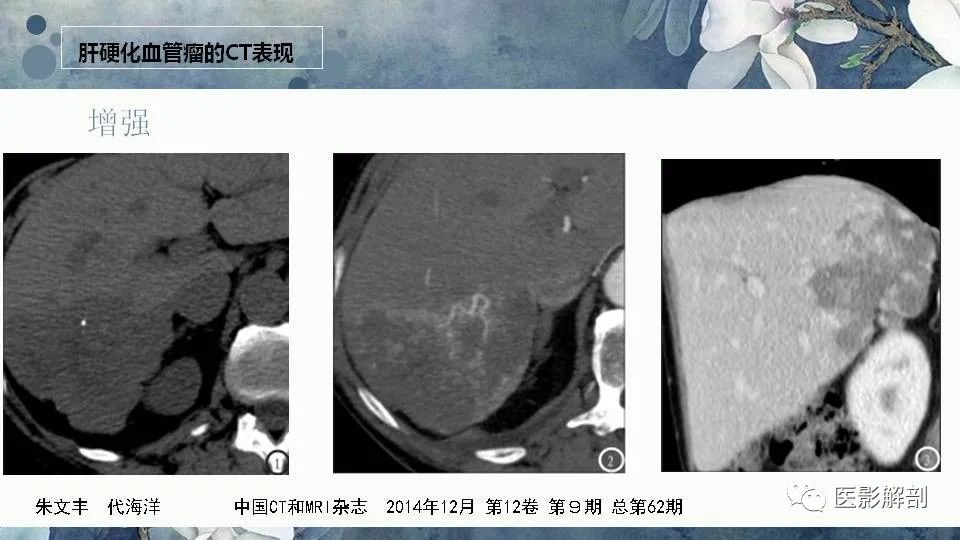影像PPT - 【PPT】肝血管瘤的分型与影像学诊断-15