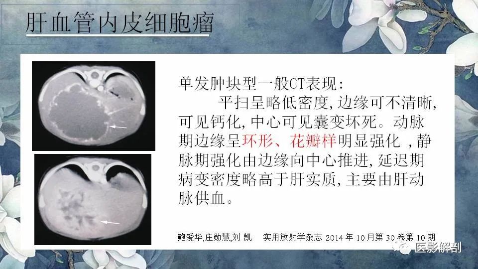 影像PPT - 【PPT】肝血管瘤的分型与影像学诊断-17