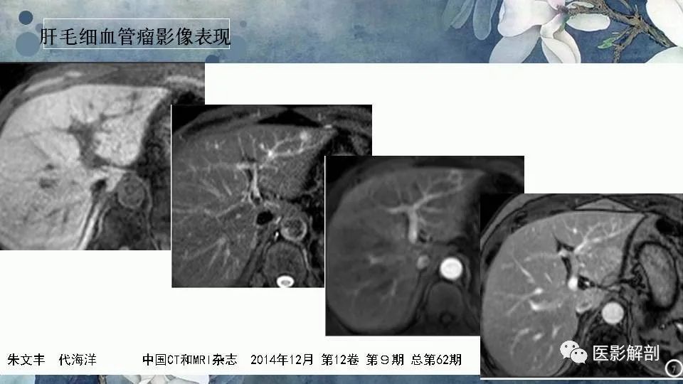 影像PPT - 【PPT】肝血管瘤的分型与影像学诊断-19