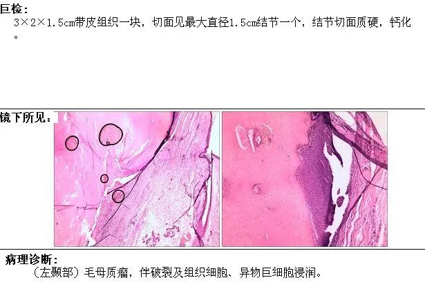 影像PPT - 【病例】颞部皮下毛母质瘤1例CT影像-5 影像PPT - 【病例】颞部皮下毛母质瘤1例CT影像-5