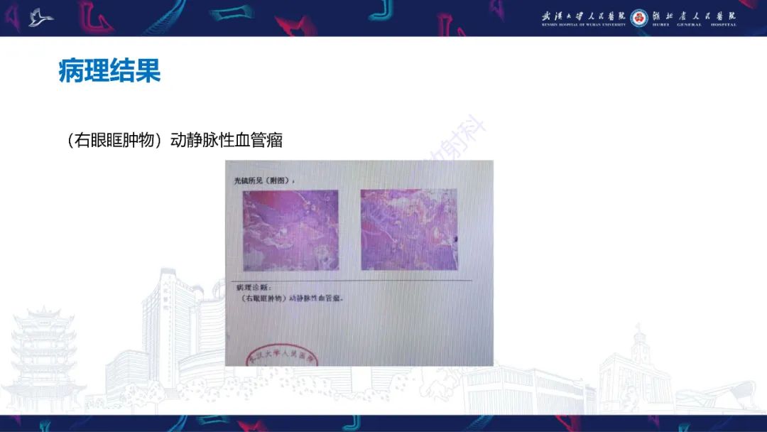 影像PPT - 【PPT】泪道病变影像诊断-4