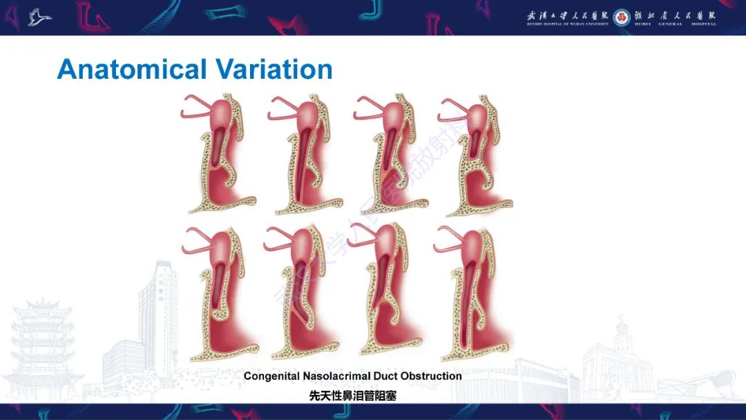 影像PPT - 【PPT】泪道病变影像诊断-9