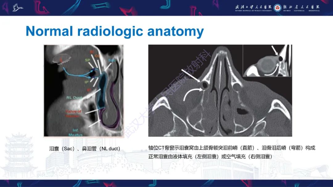 影像PPT - 【PPT】泪道病变影像诊断-11