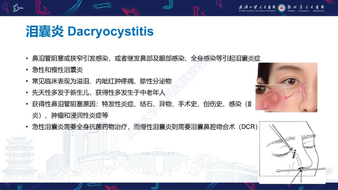 影像PPT - 【PPT】泪道病变影像诊断-15