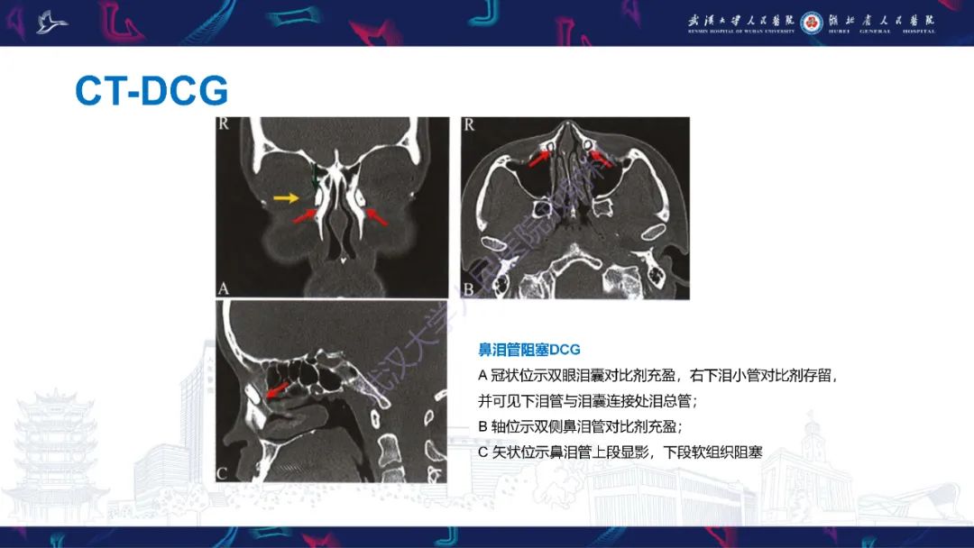 影像PPT - 【PPT】泪道病变影像诊断-14