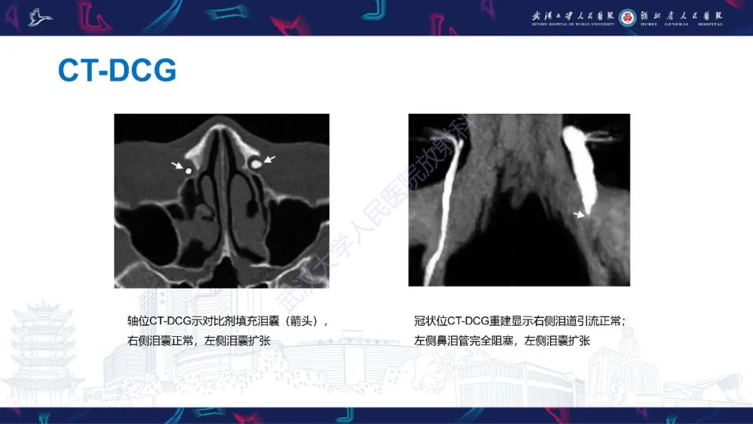 影像PPT - 【PPT】泪道病变影像诊断-13