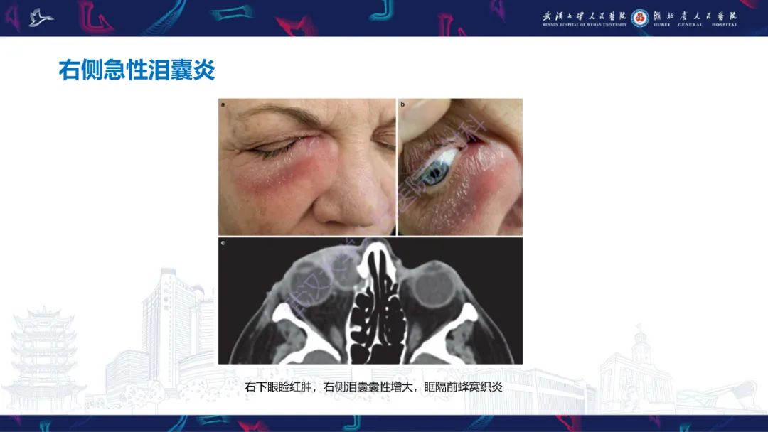 影像PPT - 【PPT】泪道病变影像诊断-16