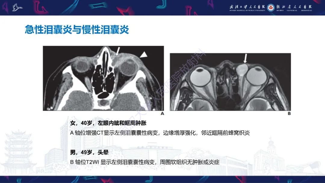 影像PPT - 【PPT】泪道病变影像诊断-17