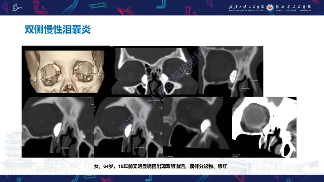 影像PPT - 【PPT】泪道病变影像诊断-18