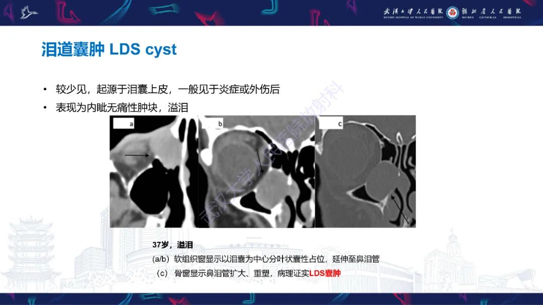 影像PPT - 【PPT】泪道病变影像诊断-19