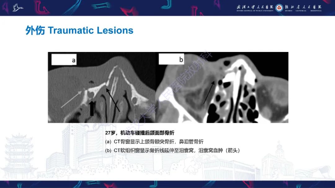 影像PPT - 【PPT】泪道病变影像诊断-22
