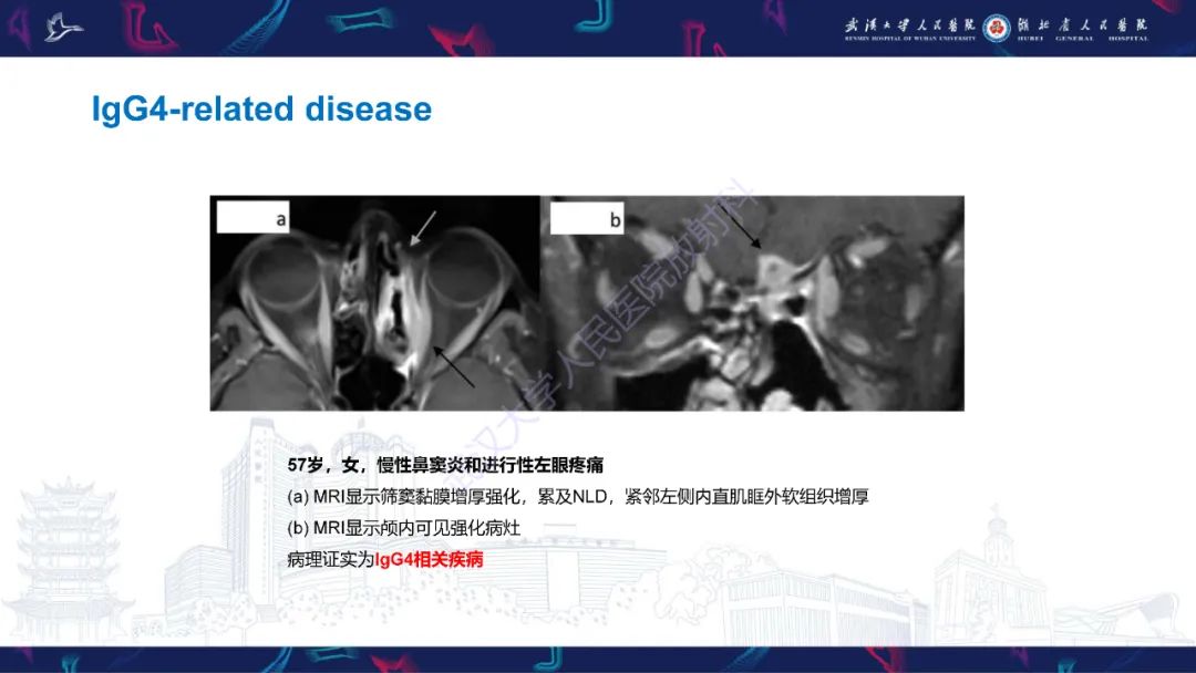 影像PPT - 【PPT】泪道病变影像诊断-26