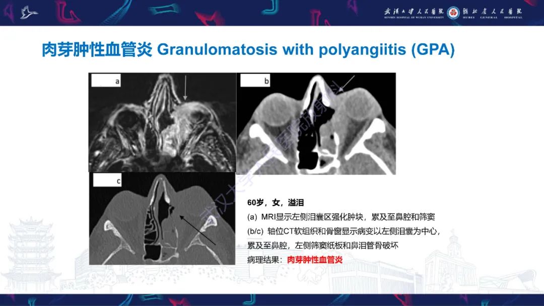 影像PPT - 【PPT】泪道病变影像诊断-25