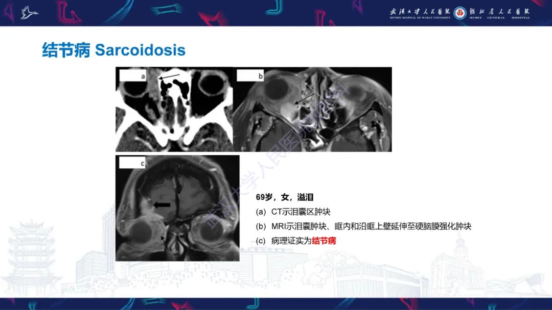 影像PPT - 【PPT】泪道病变影像诊断-27