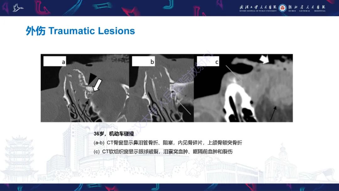 影像PPT - 【PPT】泪道病变影像诊断-23