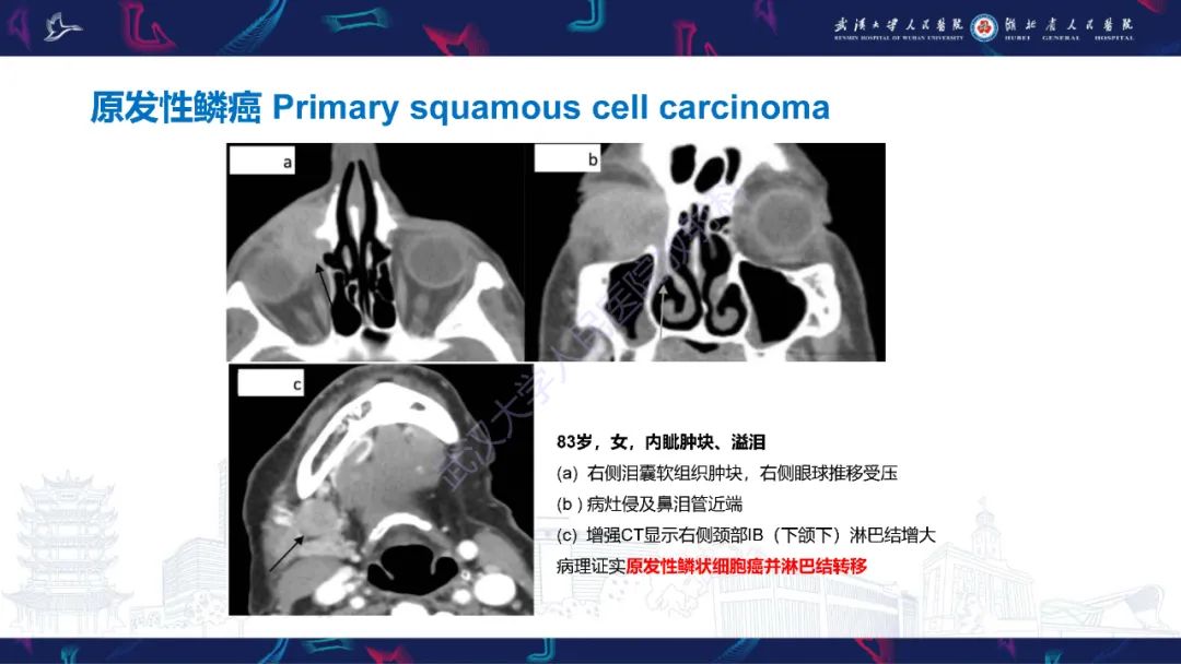 影像PPT - 【PPT】泪道病变影像诊断-31