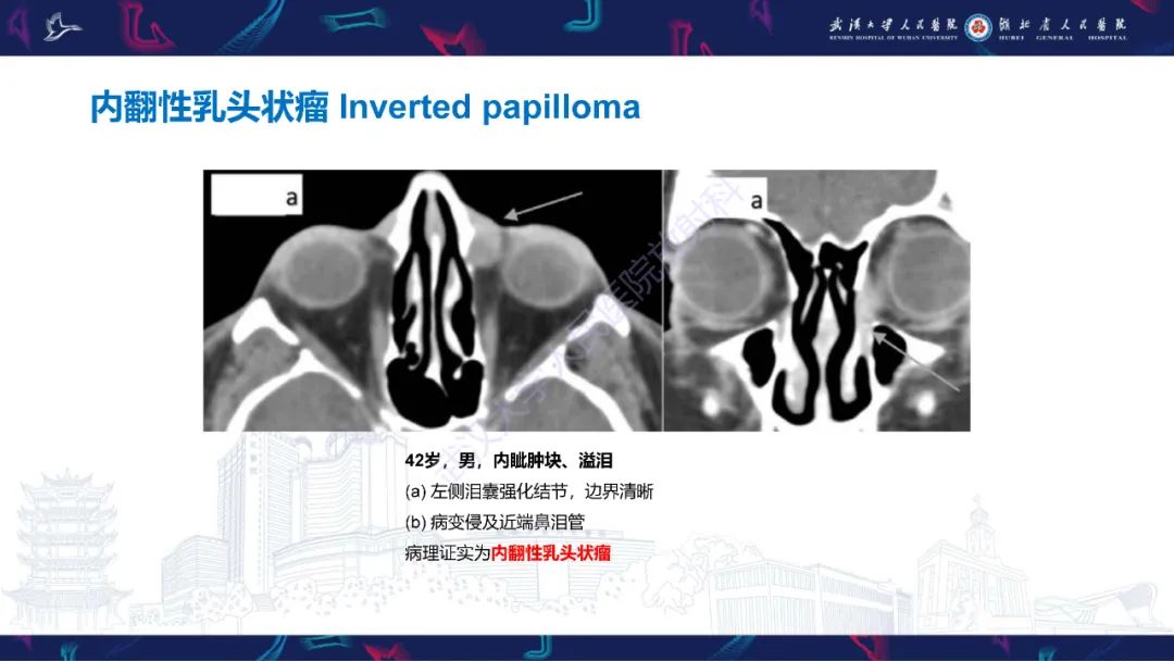 影像PPT - 【PPT】泪道病变影像诊断-30