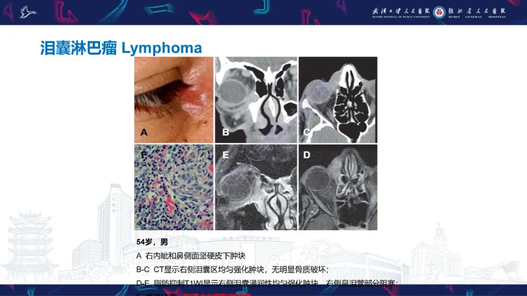 影像PPT - 【PPT】泪道病变影像诊断-36