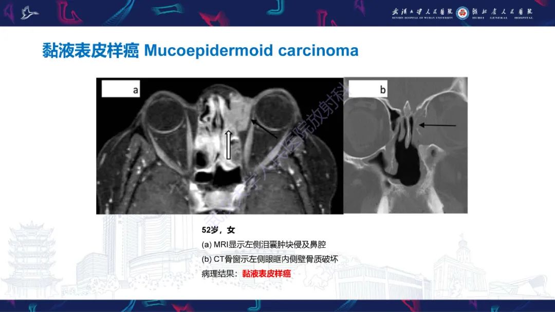 影像PPT - 【PPT】泪道病变影像诊断-34