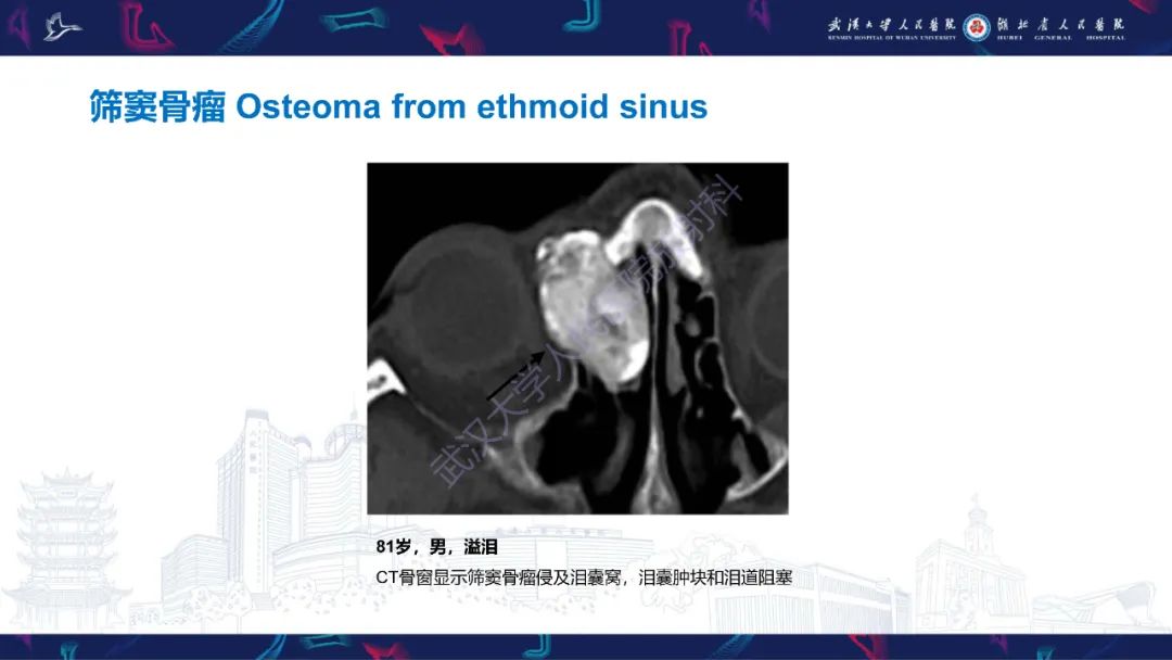 影像PPT - 【PPT】泪道病变影像诊断-38